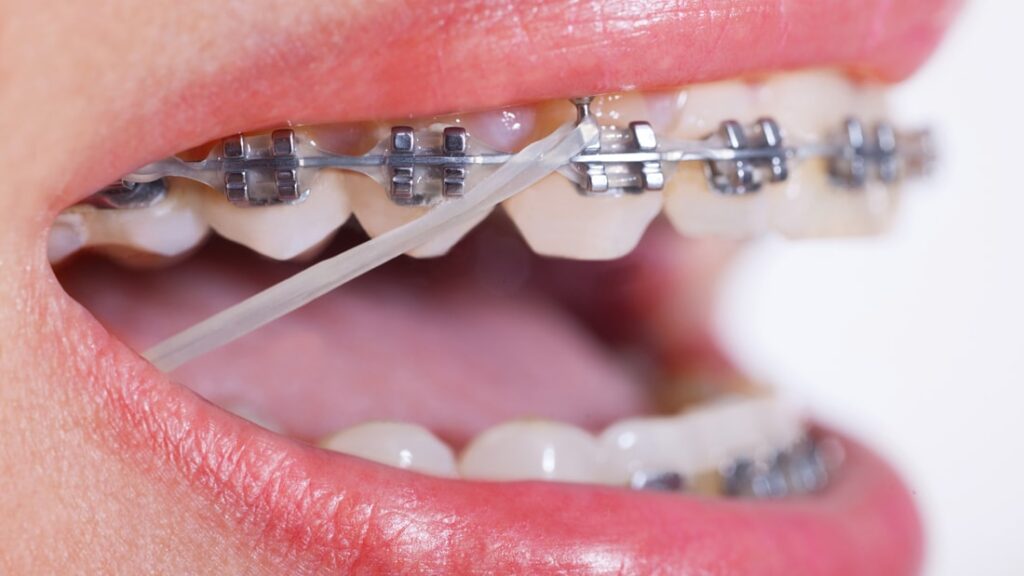 Invisalign Cost